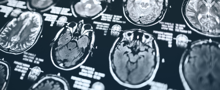 Scan of the brain after a brain injury