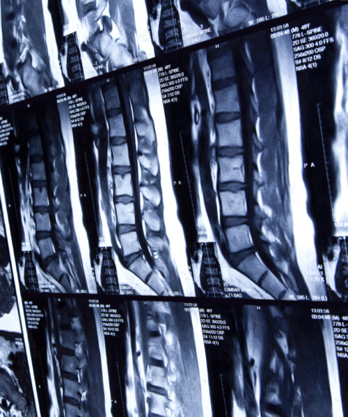 MRI scan of human lumbar spine