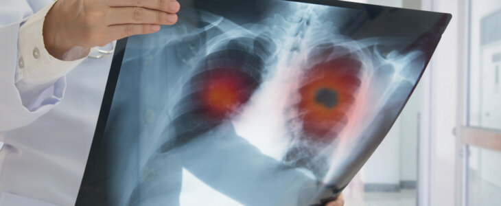 x-ray of lung cancer