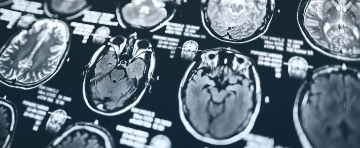 Scan of the brain after a brain injury