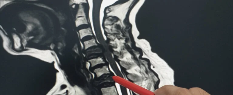 MRI C-Spine Examination the patient severely spondylosis or bone tumor.