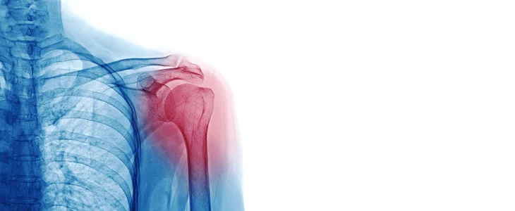 Disclocation in the shoulder